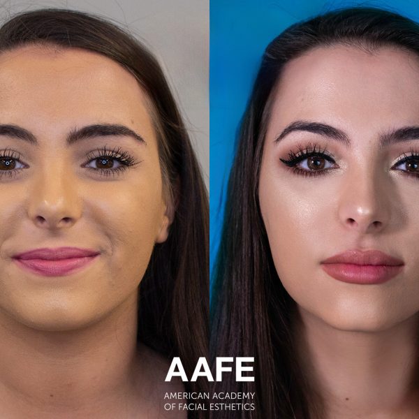 Virtual: Botox Blueprint For Dentists - How to Add $10K-$50K Monthly to Your Dental Practice—Without New Patients or Equipment